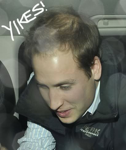 prince william getting bald young. prince william hair thinning.